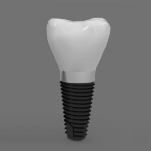 dentalimplant1_web DentalImplant