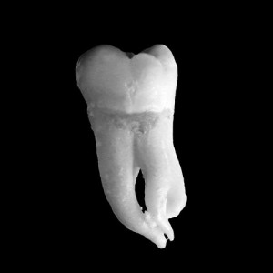 wisdomtooth_web WisdomTooth
